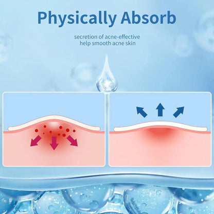 Invisible Acne Patches for Clear, Smooth Skin – 180/360PCS