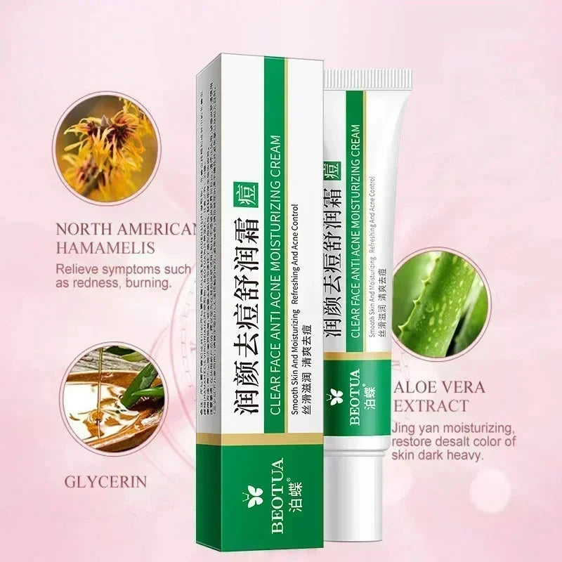 Herbal Acne Treatment Cream for Clear, Smooth Skin