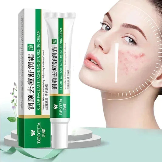 Herbal Acne Treatment Cream for Clear, Smooth Skin